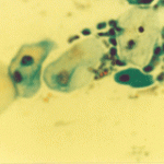 Χαρακτηιστικές ατυπίες έρπητος, σε ολες τις στοιβάδες του επιθηλίου